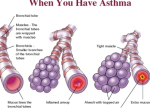 cara mengobati asma